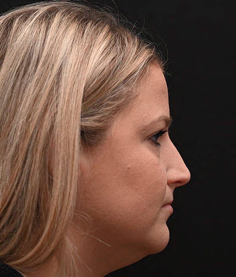 Functional Rhinoplasty Before & After Gallery - Patient 175596 - Image 11