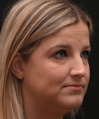Rhinoplasty Before & After Gallery - Patient 212758 - Image 1