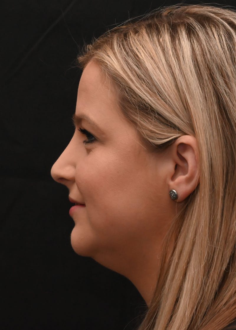 Rhinoplasty Before & After Gallery - Patient 212758 - Image 10