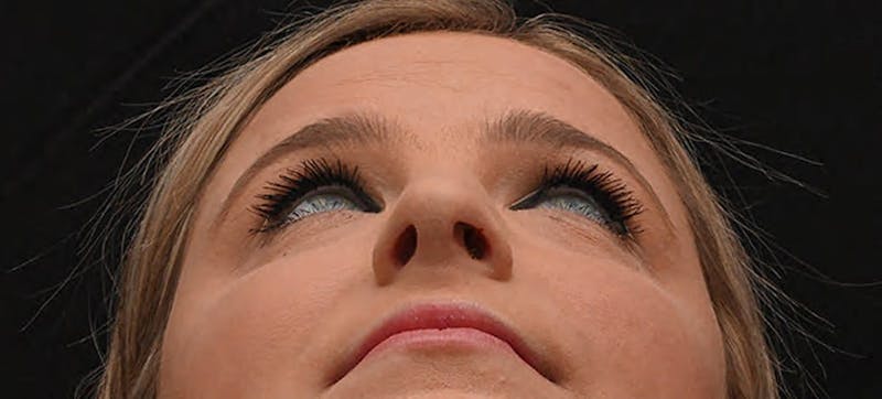 Rhinoplasty Before & After Gallery - Patient 212758 - Image 8