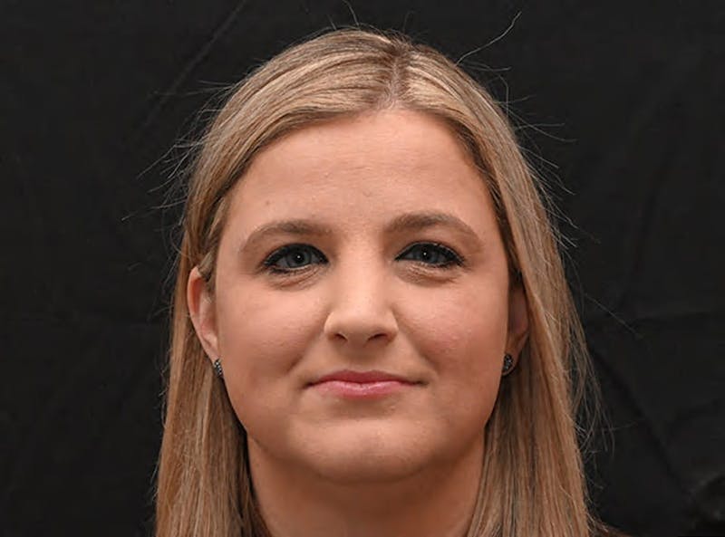 Rhinoplasty Before & After Gallery - Patient 212758 - Image 6