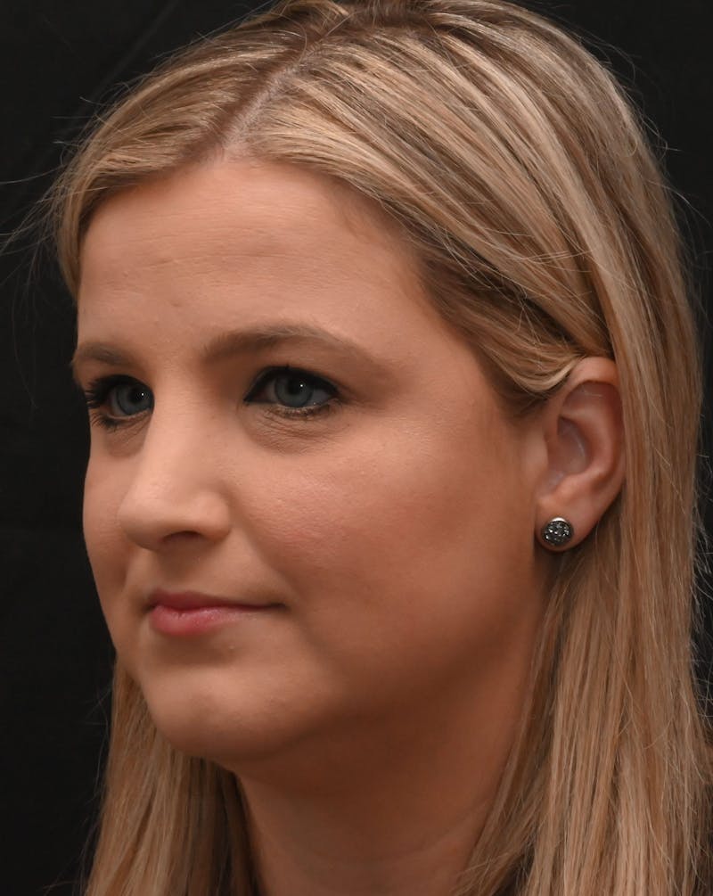 Rhinoplasty Before & After Gallery - Patient 212758 - Image 4
