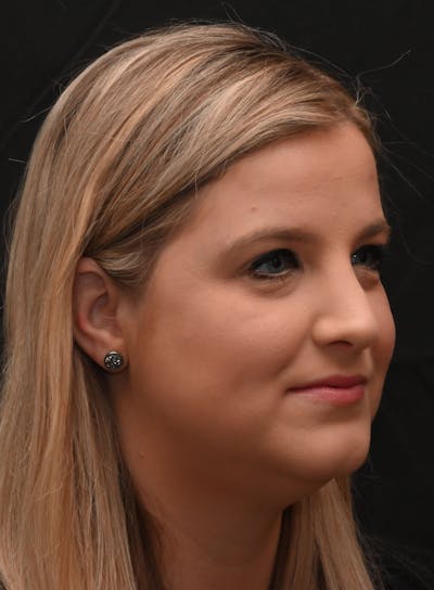 Rhinoplasty Before & After Gallery - Patient 212758 - Image 2