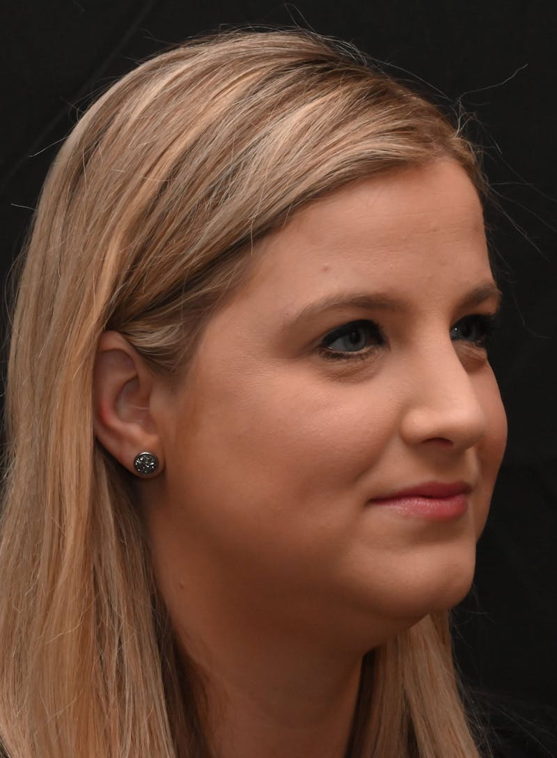 Rhinoplasty Before & After Gallery - Patient 212758 - Image 2