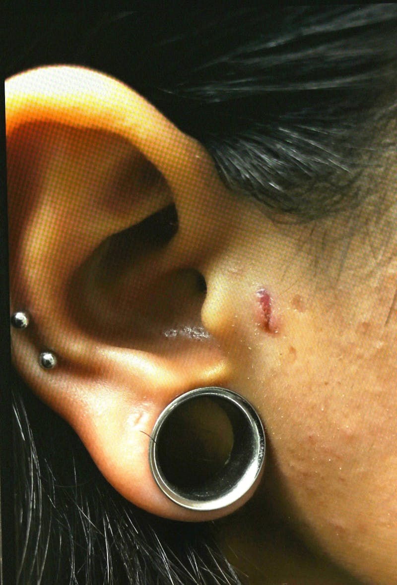 Earlobe Repair Before & After Gallery - Patient 180852 - Image 3