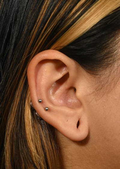 Earlobe Repair Before & After Gallery - Patient 180852 - Image 1