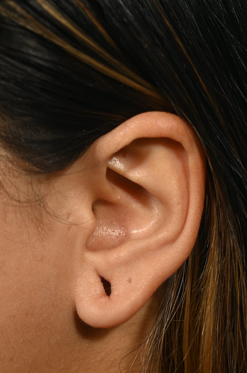 Earlobe Repair Before & After Gallery - Patient 180852 - Image 5