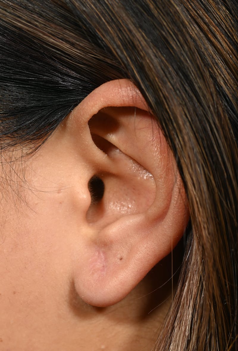 Earlobe Repair Before & After Gallery - Patient 180852 - Image 6