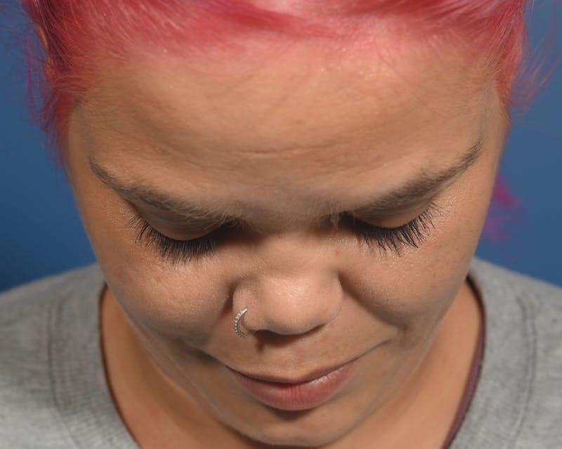 Rhinoplasty Before & After Gallery - Patient 207160 - Image 5