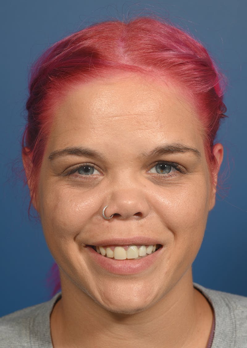 Rhinoplasty Before & After Gallery - Patient 207160 - Image 3