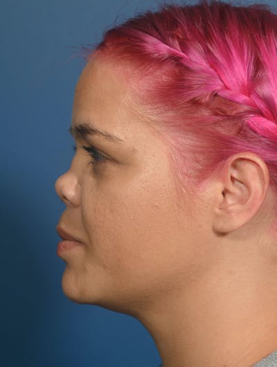 Rhinoplasty Before & After Gallery - Patient 207160 - Image 1