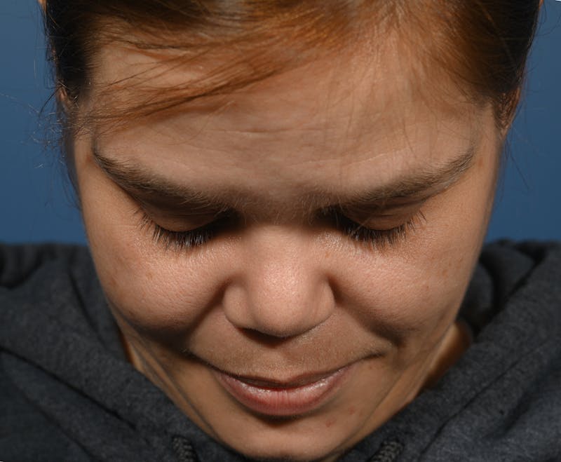 Rhinoplasty Before & After Gallery - Patient 207160 - Image 6