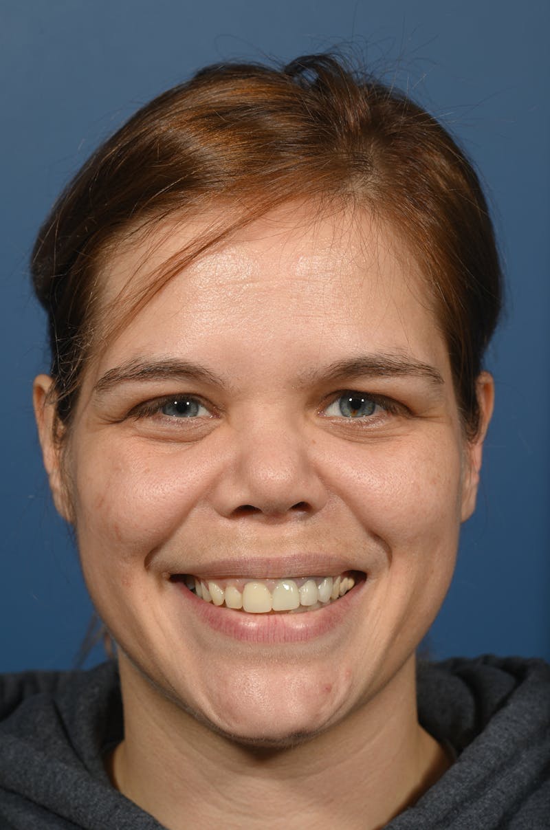 Rhinoplasty Before & After Gallery - Patient 207160 - Image 4