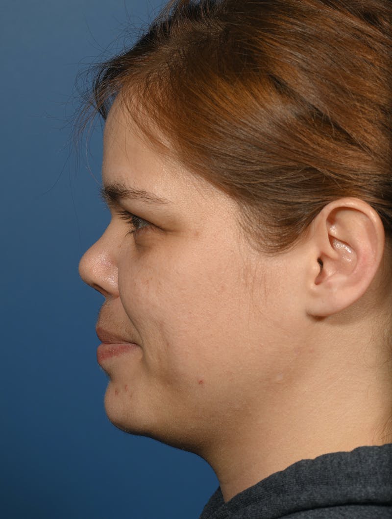 Rhinoplasty Before & After Gallery - Patient 207160 - Image 2