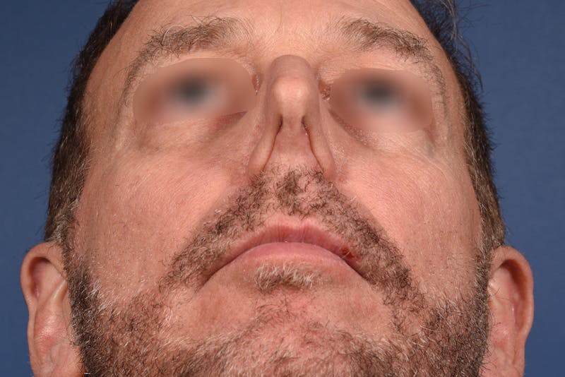 Rhinoplasty Before & After Gallery - Patient 306957 - Image 7