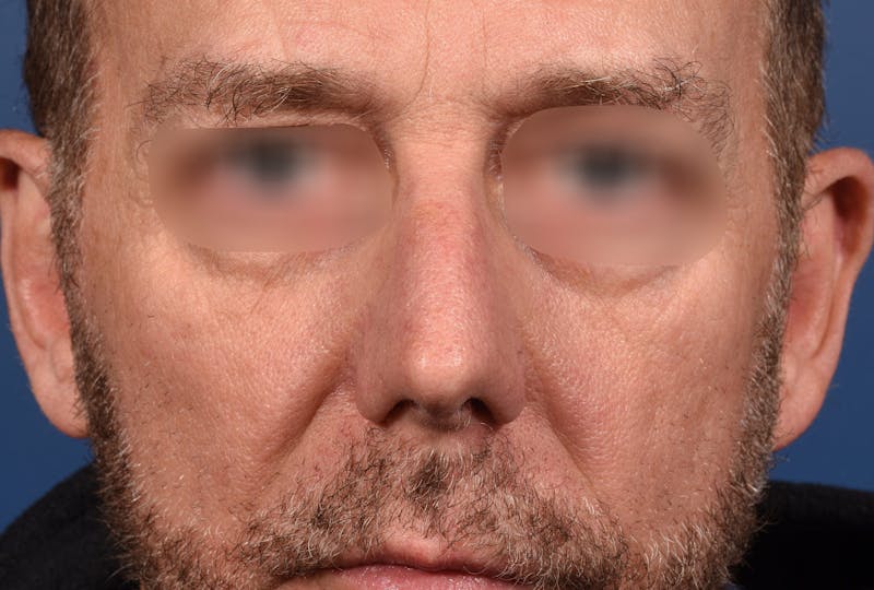 Rhinoplasty Before & After Gallery - Patient 306957 - Image 5