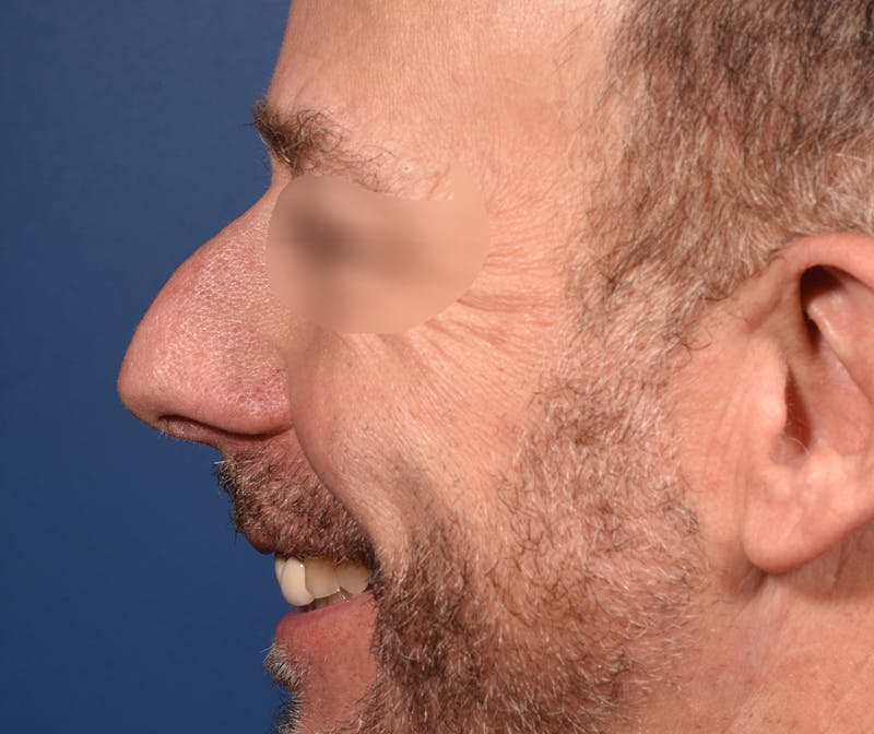Rhinoplasty Before & After Gallery - Patient 306957 - Image 3