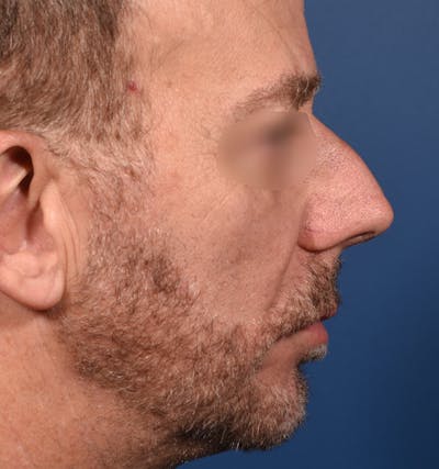 Rhinoplasty Before & After Gallery - Patient 306957 - Image 1