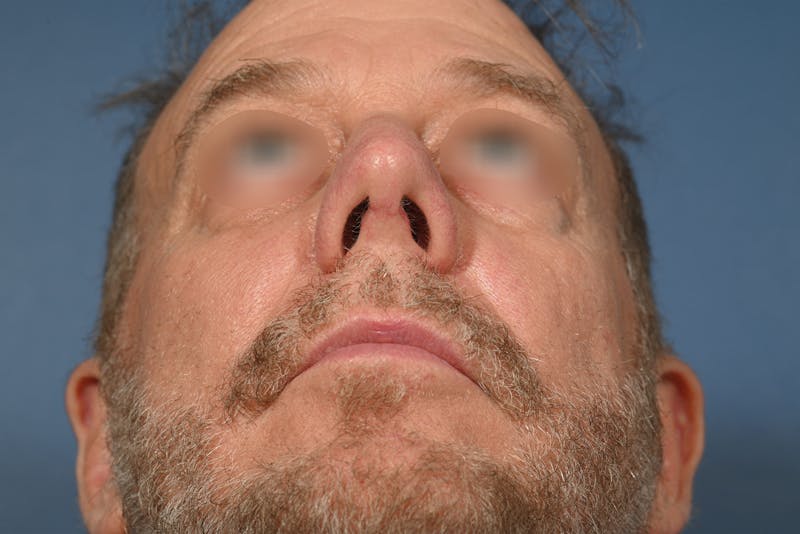 Rhinoplasty Before & After Gallery - Patient 306957 - Image 8