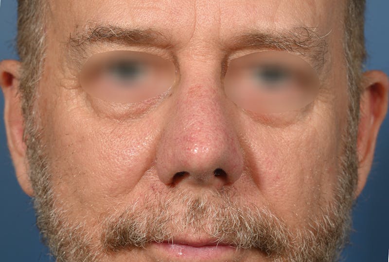 Rhinoplasty Before & After Gallery - Patient 306957 - Image 6