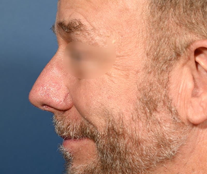 Rhinoplasty Before & After Gallery - Patient 306957 - Image 4