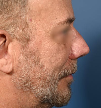 Rhinoplasty Before & After Gallery - Patient 306957 - Image 2