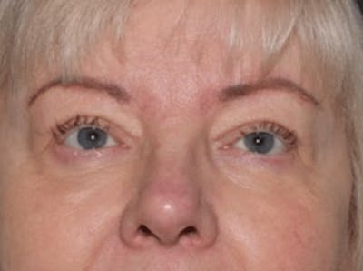 Blepharoplasty Before & After Gallery - Patient 107212 - Image 2