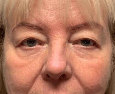 Blepharoplasty Before & After Gallery - Patient 107212 - Image 1