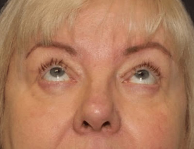 Blepharoplasty Before & After Gallery - Patient 107212 - Image 4