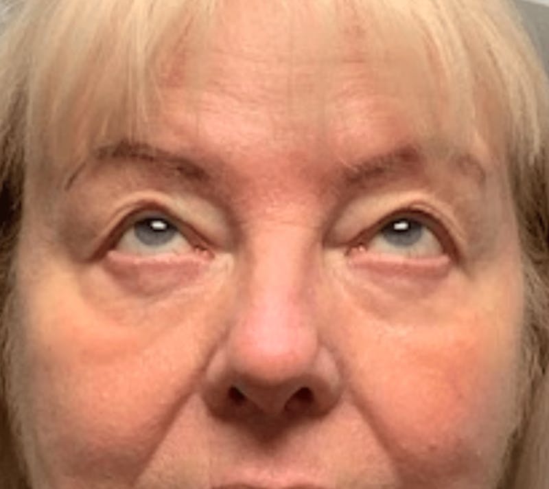 Blepharoplasty Before & After Gallery - Patient 107212 - Image 3