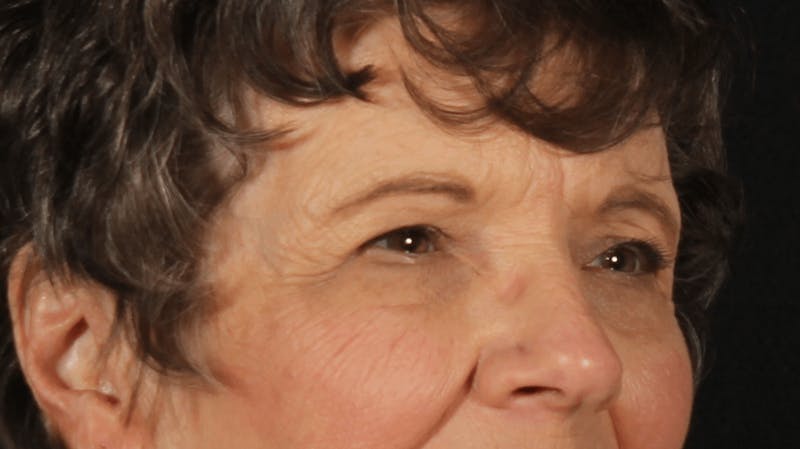 Blepharoplasty Before & After Gallery - Patient 162427 - Image 1