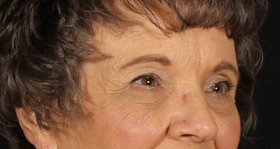 Blepharoplasty Before & After Gallery - Patient 162427 - Image 2