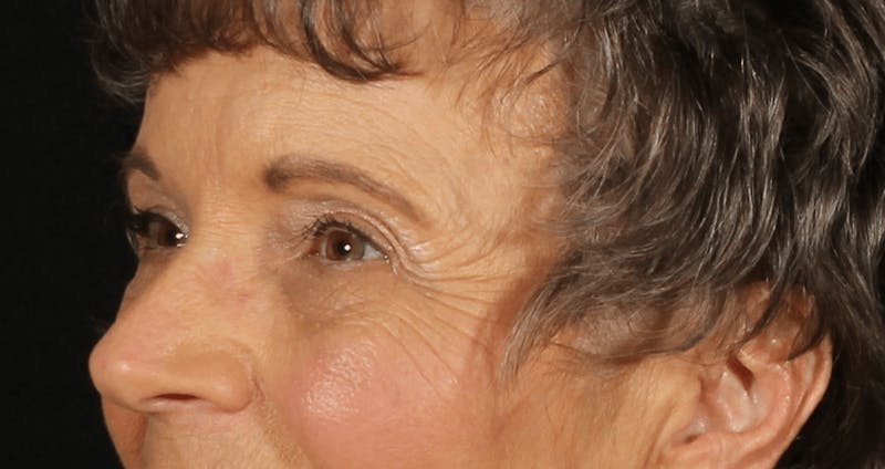 Blepharoplasty Before & After Gallery - Patient 162427 - Image 4