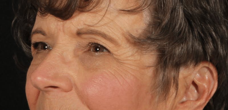 Blepharoplasty Before & After Gallery - Patient 162427 - Image 3