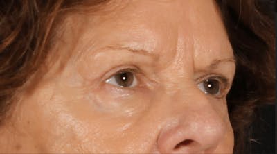 Blepharoplasty Before & After Gallery - Patient 438989 - Image 2