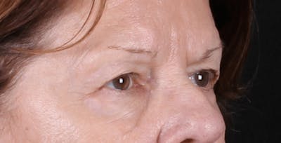 Blepharoplasty Before & After Gallery - Patient 438989 - Image 1