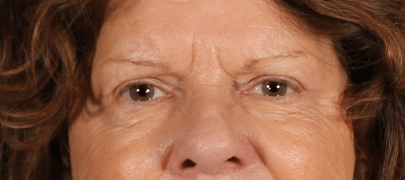 Blepharoplasty Before & After Gallery - Patient 438989 - Image 4