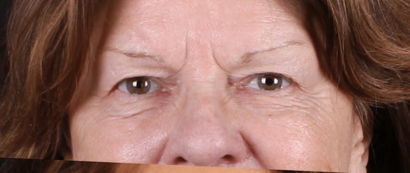 Blepharoplasty Before & After Gallery - Patient 438989 - Image 3