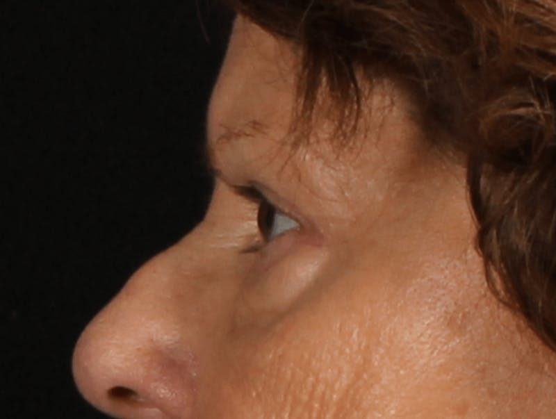Blepharoplasty Before & After Gallery - Patient 438989 - Image 6