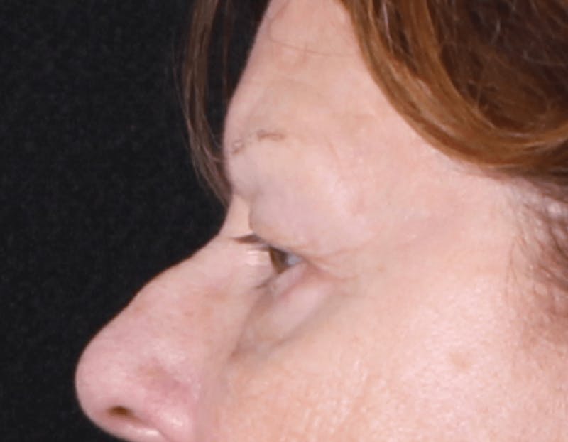 Blepharoplasty Before & After Gallery - Patient 438989 - Image 5