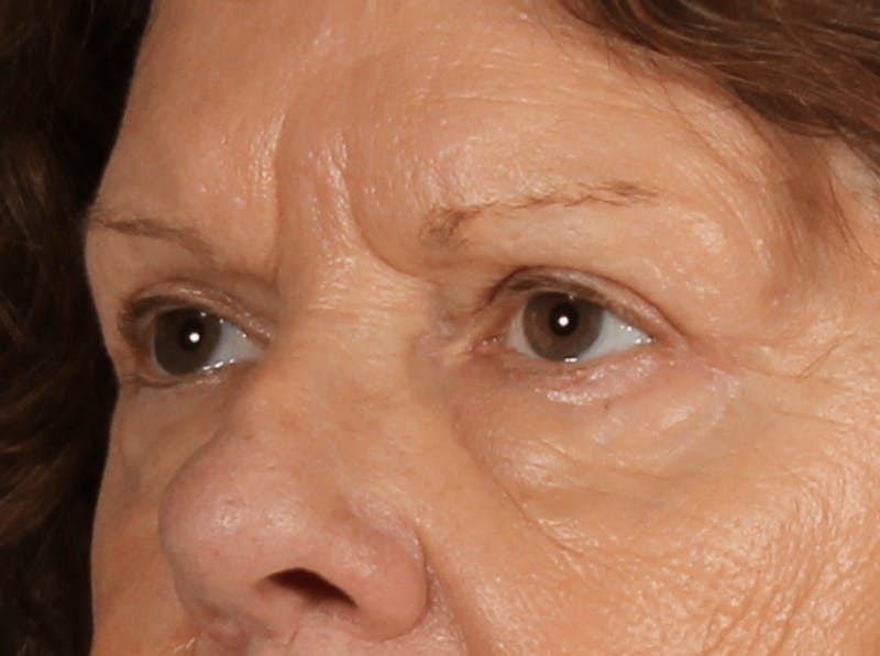Blepharoplasty Before & After Gallery - Patient 438989 - Image 8