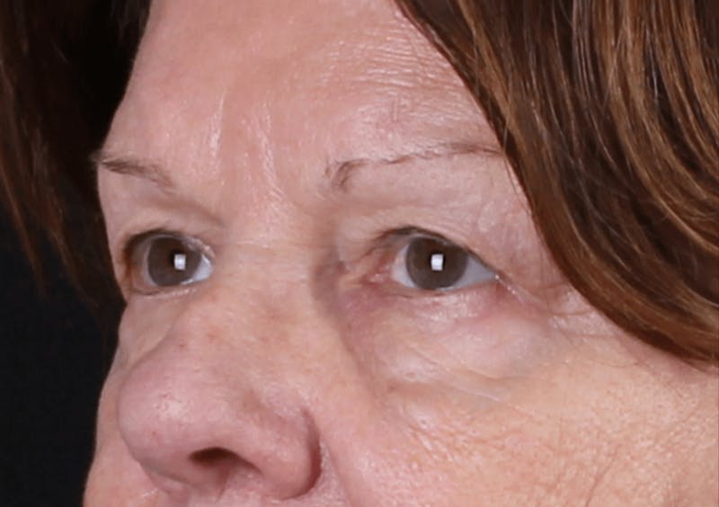 Blepharoplasty Before & After Gallery - Patient 438989 - Image 7