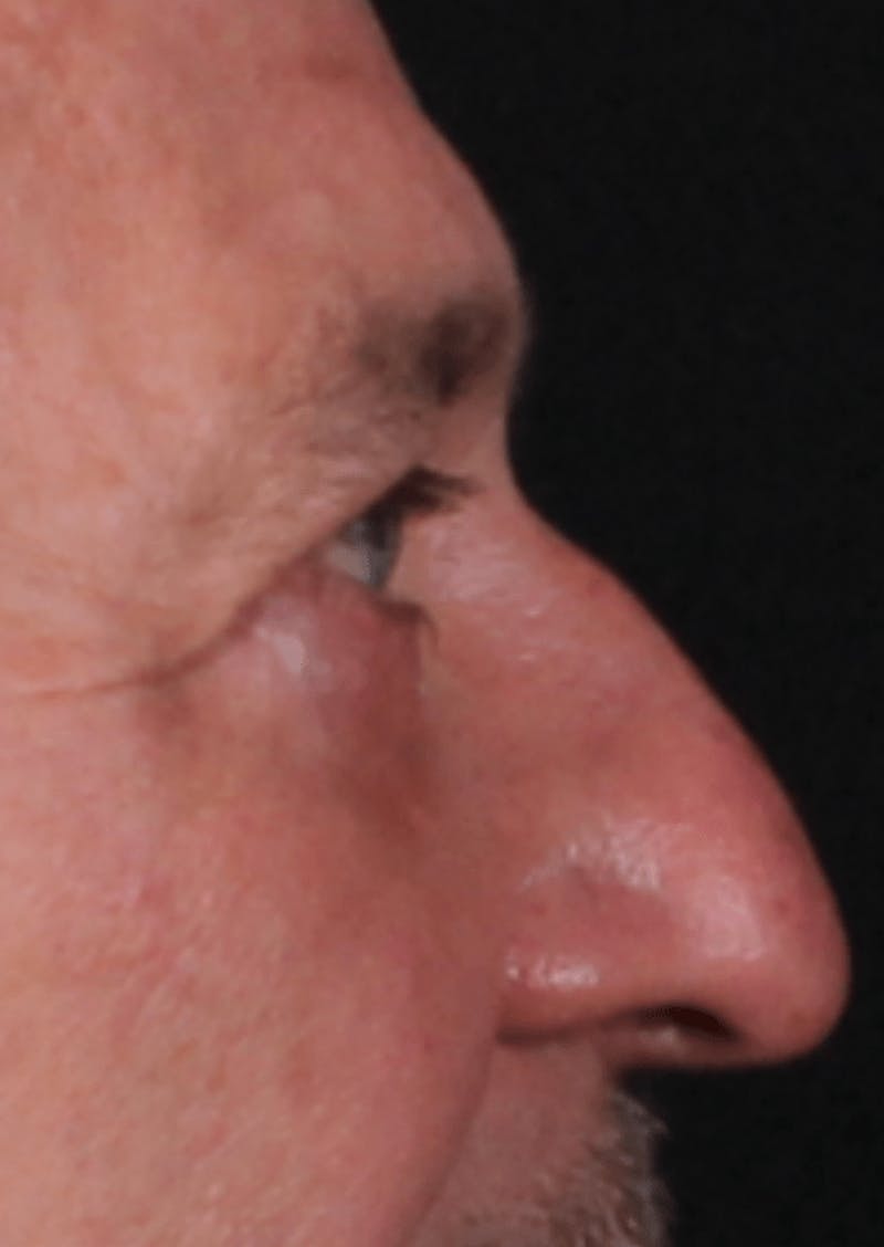 Blepharoplasty Before & After Gallery - Patient 391464 - Image 6