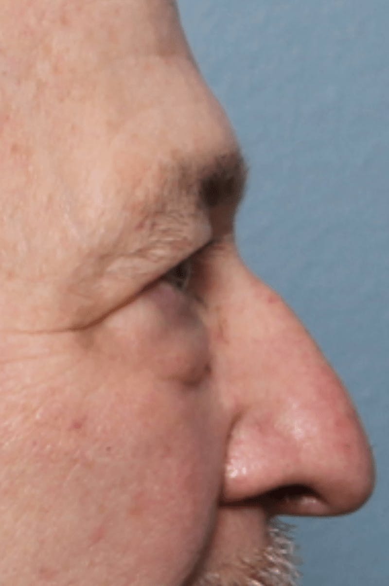 Blepharoplasty Before & After Gallery - Patient 391464 - Image 5
