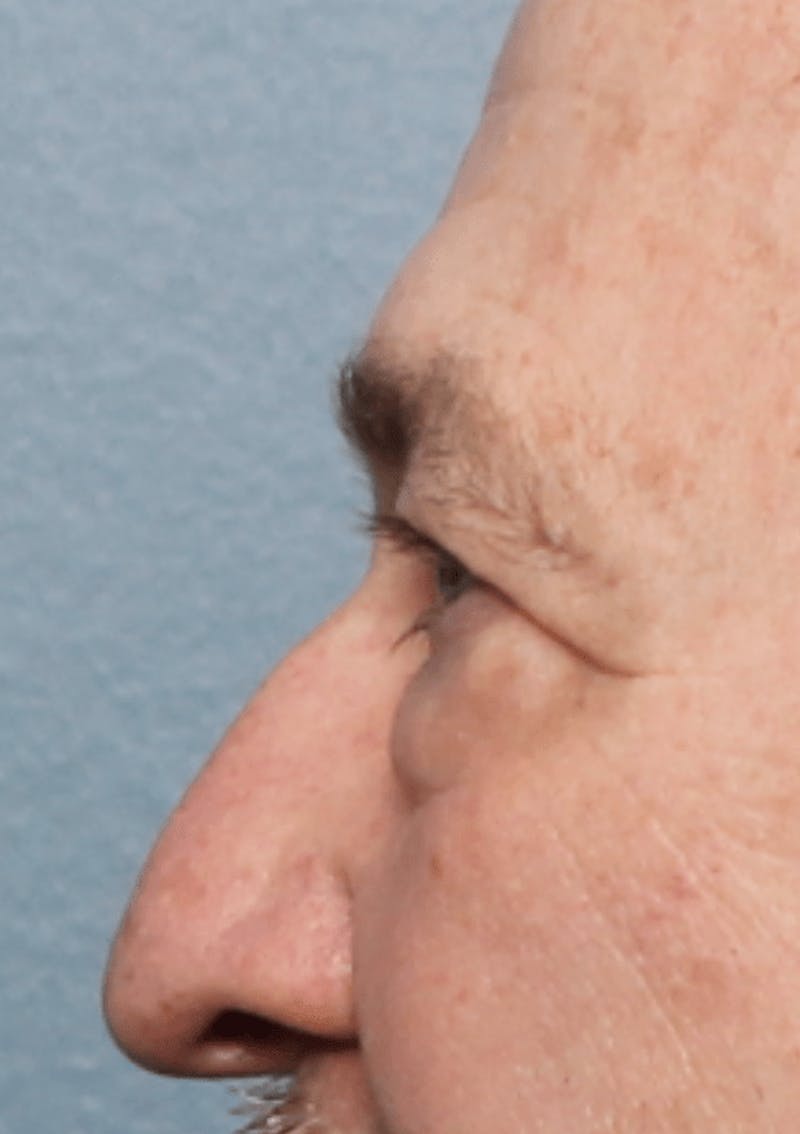 Blepharoplasty Before & After Gallery - Patient 391464 - Image 7