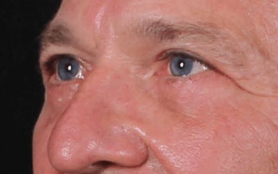 Blepharoplasty Before & After Gallery - Patient 391464 - Image 2