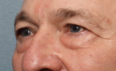 Blepharoplasty Before & After Gallery - Patient 391464 - Image 1