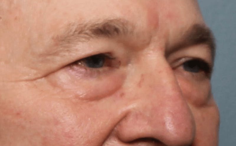 Blepharoplasty Before & After Gallery - Patient 391464 - Image 3