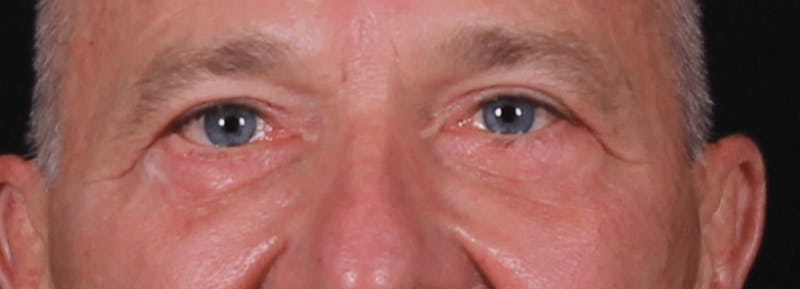 Blepharoplasty Before & After Gallery - Patient 391464 - Image 10