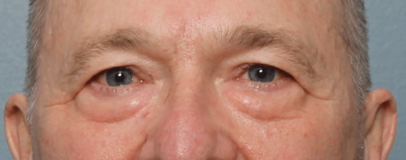 Blepharoplasty Before & After Gallery - Patient 391464 - Image 9